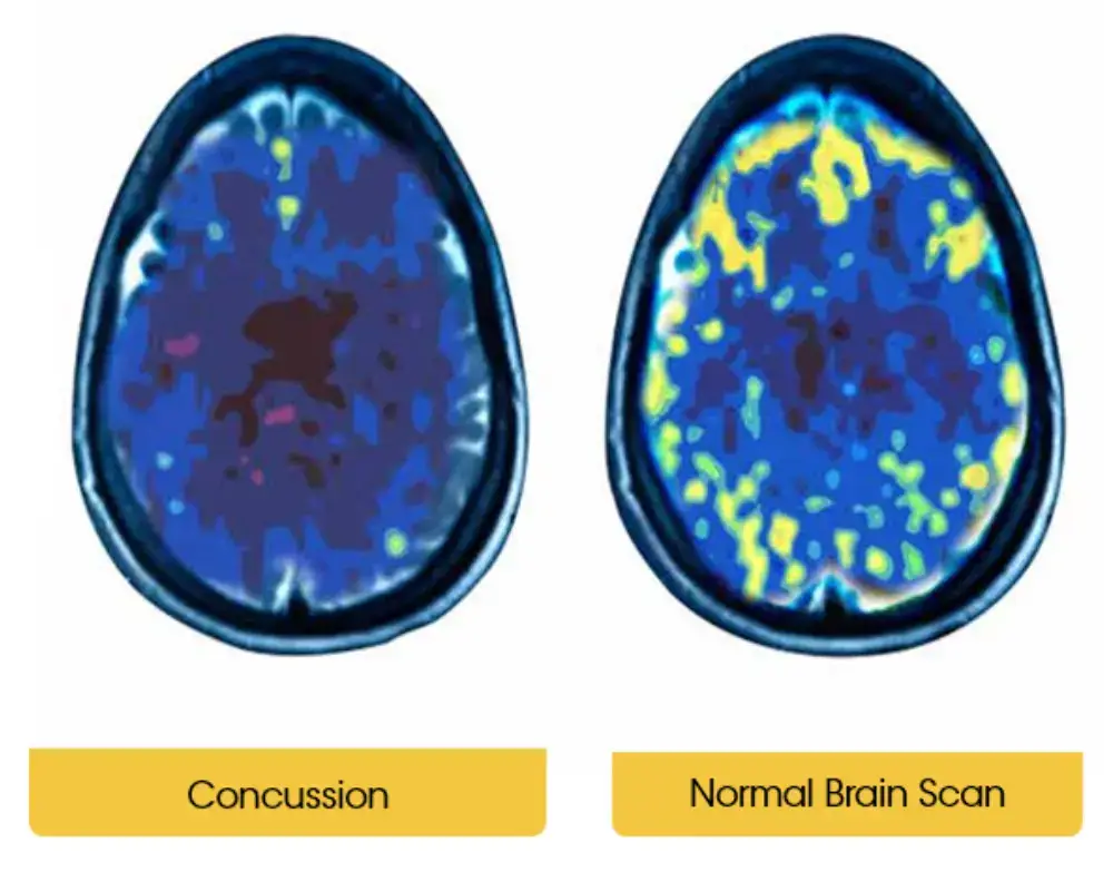 Concussion syndrome